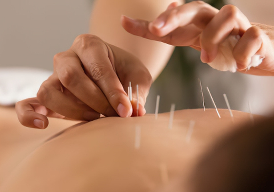 Two hands hover over acupuncture needles sticking out of a patient's back.